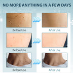 WA1000 Skin Tag Remover with Freeze Off Technology, Effective Skin Tag Removal Device, Home Use Cryo Kit for 1-2 Week Results + 10 Use Cycles