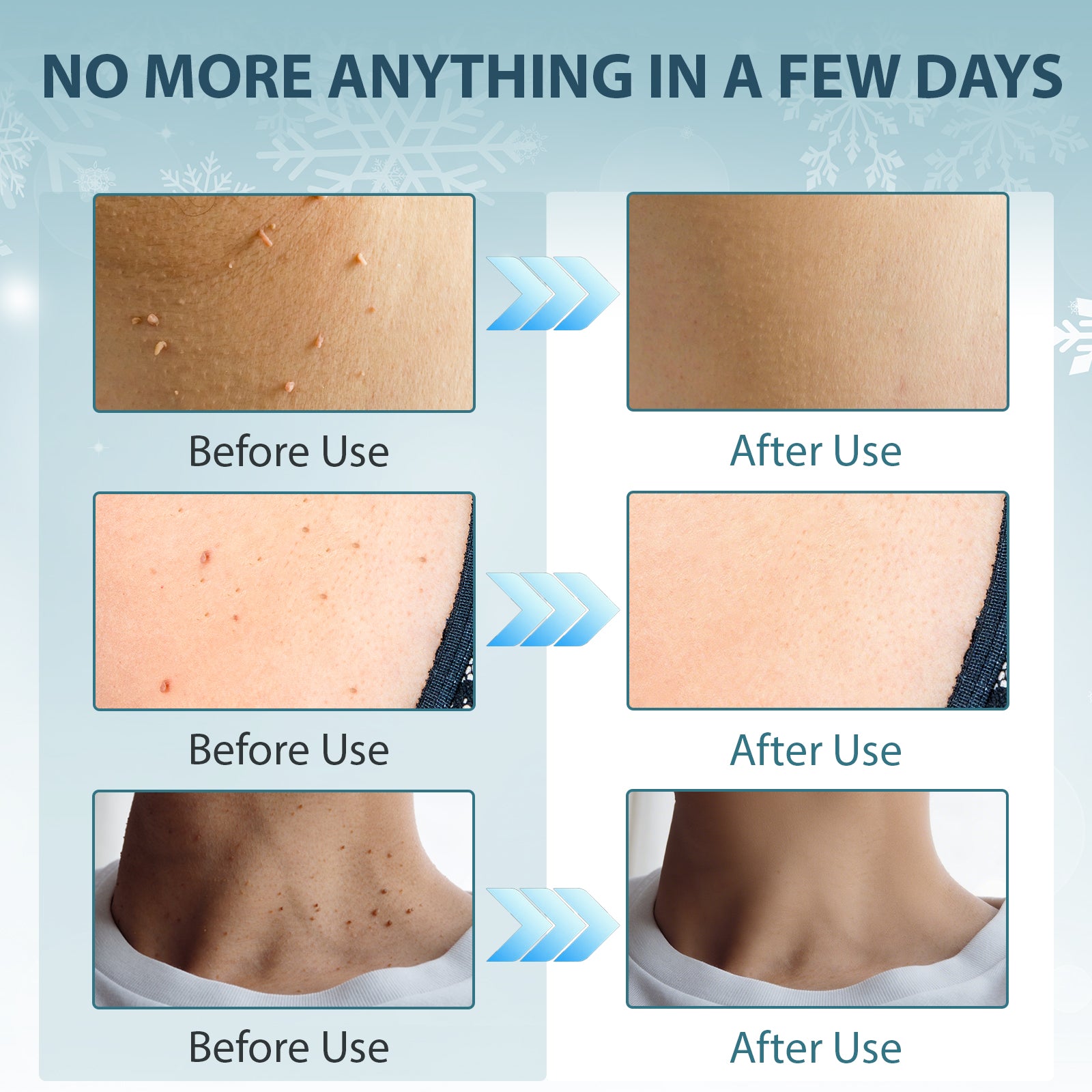 WA1000 Skin Tag Remover with Freeze Off Technology, Effective Skin Tag Removal Device, Home Use Cryo Kit for 1-2 Week Results + 10 Use Cycles